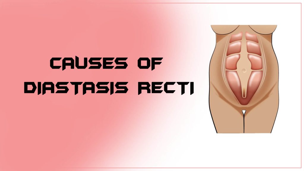 Causes of Diastasis Recti